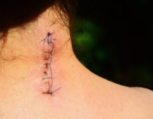 Neck Injury Compensation Claim Solicitors. Specialist Accident Claims Lawyers Neck Injury Compensation Claim Solicitors. Specialist Accident Claims Lawyers